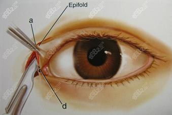 张冰洁做内眼角修复示意图