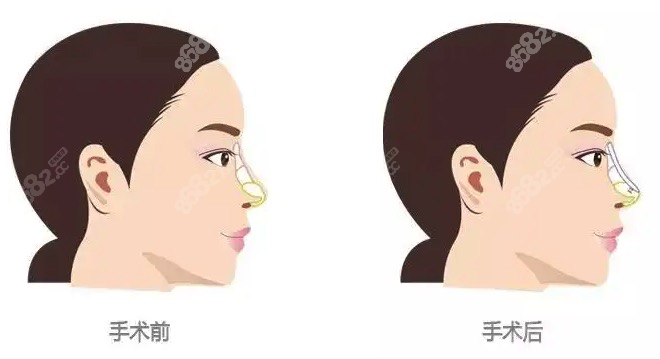 甘海勇醫(yī)生隆鼻技術(shù)優(yōu)勢(shì)