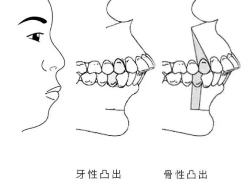 骨性前突图解