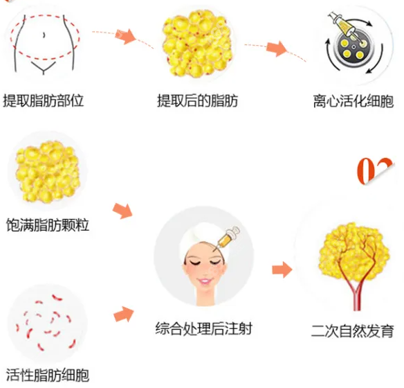王俊河脂肪填充操作圖示
