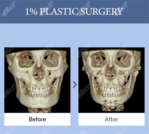 韩国1%整形颧骨ct