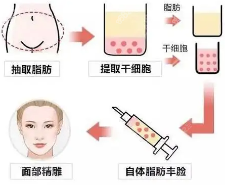 王仁根醫(yī)生脂肪填充過程圖示