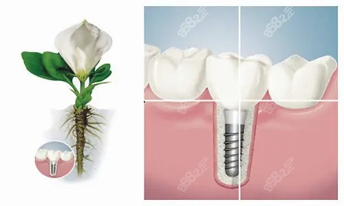 中家医家庭医生口腔种植牙技术好