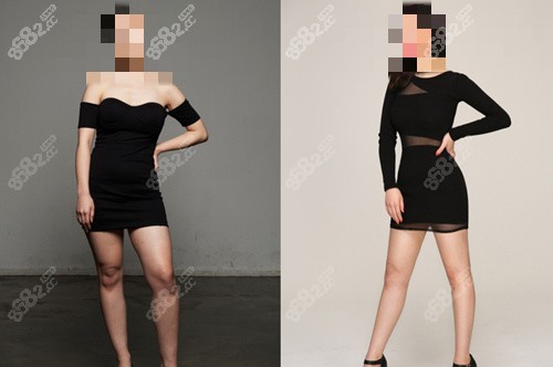 韩国必当归整形外科腰腹吸脂靠谱吗