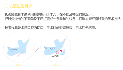 韩国珠儿丽整形外科医院轮廓手术原理