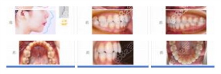 上海杨国平正畸病例多方对比图 上海杨国平正畸病例多方对比图