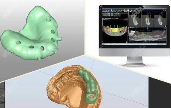 承德可米口腔3D数字化微创种植技术