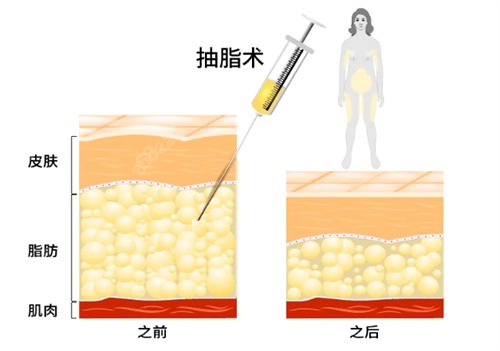 南京美贝尔吸脂