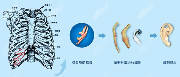 肋软骨耳廓再造手术过程