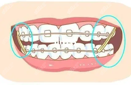 疫情期间牙齿矫正时皮筋用完了怎么应急