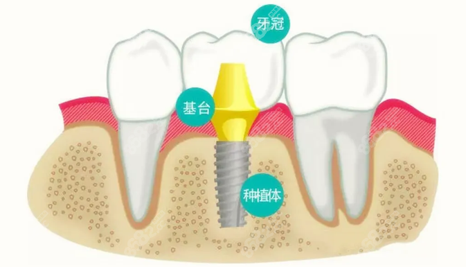 韓國登騰種植牙結(jié)構(gòu)