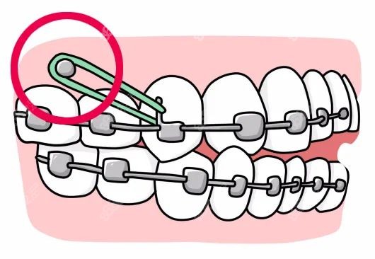 疫情期间如果牙齿矫正钢丝松了怎么办？