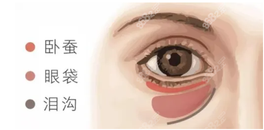 眼袋祛除过多导致眼睑外翻，泪沟凹陷