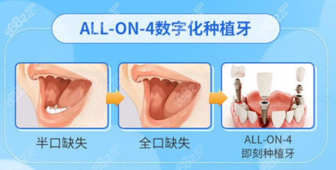 all-on-4全口种植牙技术优势