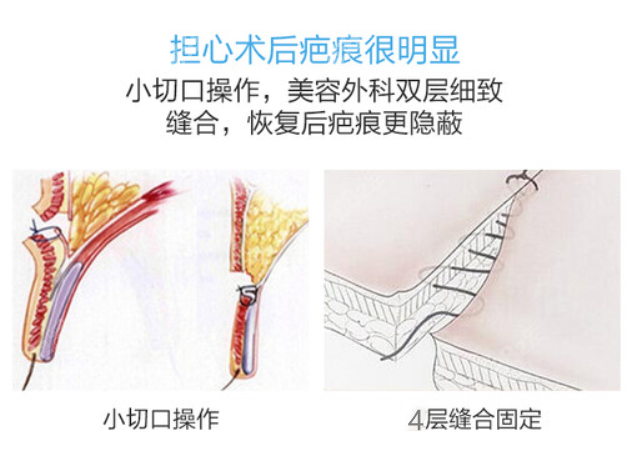 白永辉修复双眼皮的技术