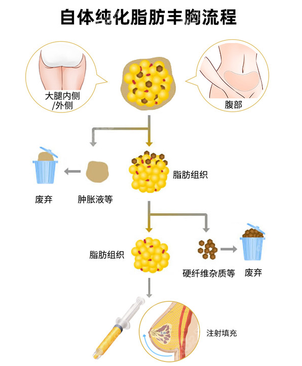 淄博做自体脂肪隆胸过程