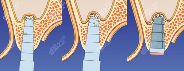 种植牙放骨粉不能长成骨头