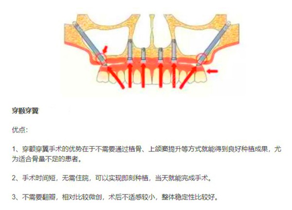 穿颧穿翼手术的优点