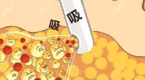 马梅生面部吸脂技术不仅好，而且收费不贵