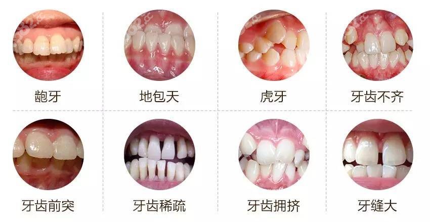 上海时代天使成人和儿童矫正牙套的价格有区别