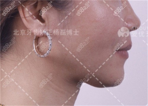 杨磊骨性凸嘴矫正后