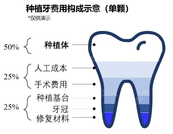 2022四川种植牙多少钱一颗