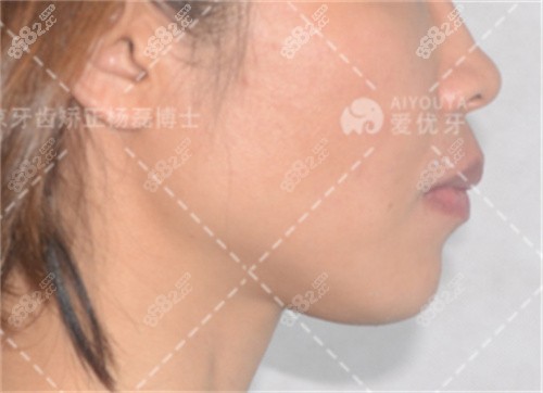 杨磊骨性凸嘴矫正前