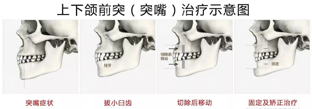 上下頜骨輕微前突，找蔣自強(qiáng)做了微創(chuàng)快速正頜手術(shù)