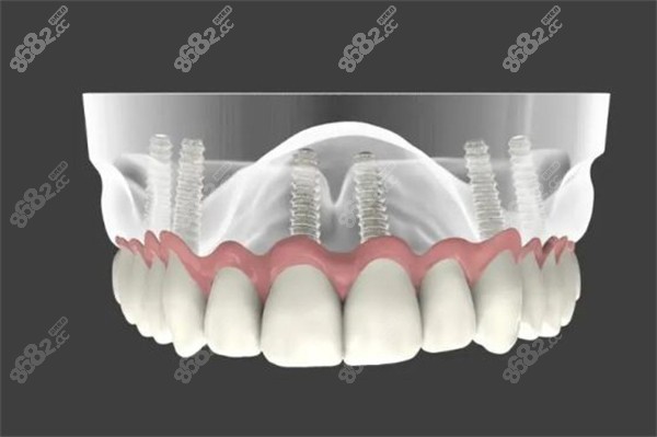 密云全口种植牙价格