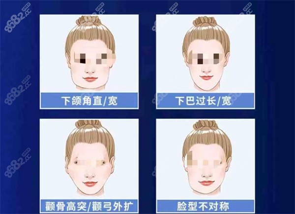 南京吳國平下頜角手術(shù)怎么樣？