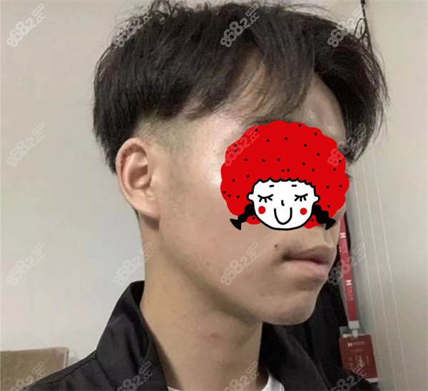 南京吳國平下頜角手術(shù)怎么樣？