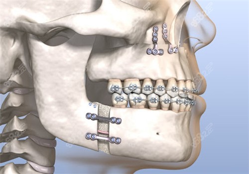 正颌手术动画图