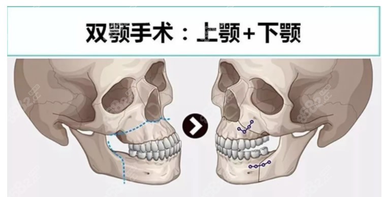 双鄂正颌手术怎么做