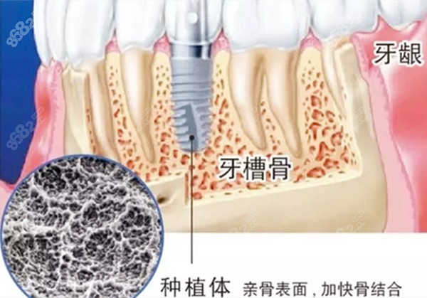 种植体亲骨表面加快骨结合