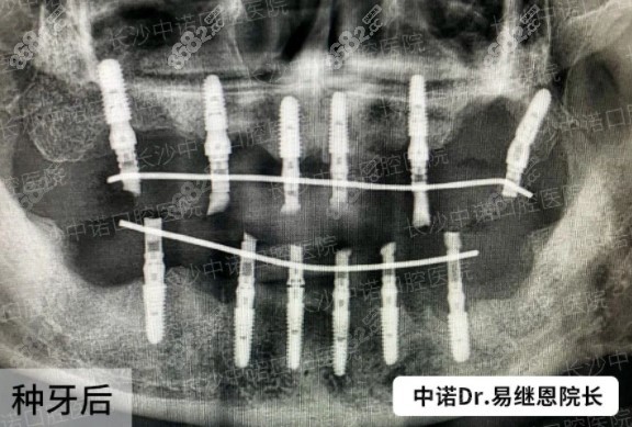 长沙中诺口腔立得用全口种植牙ct照