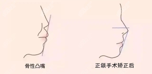 突嘴做微創(chuàng)正頜前后對比照