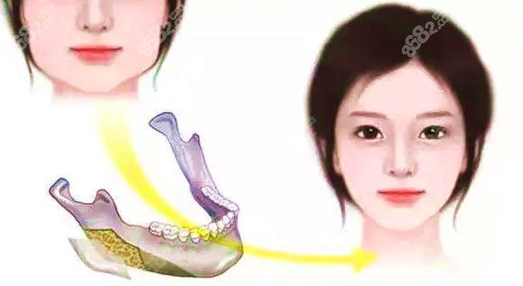 西安磨骨多少錢