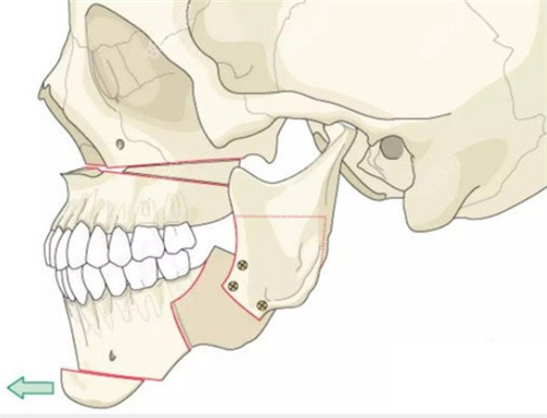 正颌手术动画展示图