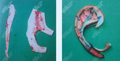 耳再造手术选自体肋软骨还是生物材料好