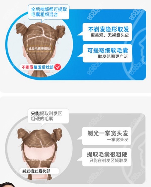 不剃发植发与传统剃发植发的区别