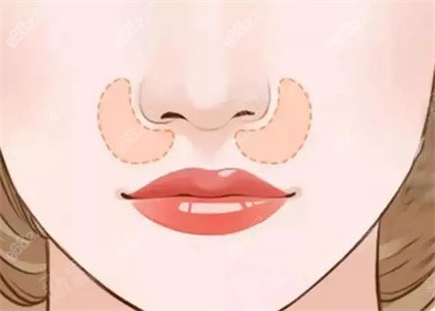 陈远琨医生隆鼻的技术优势