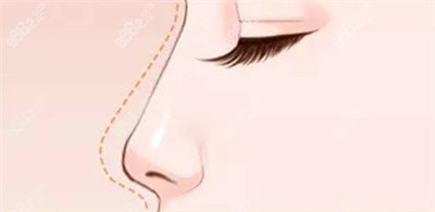 周顺波医生隆鼻的技术优势