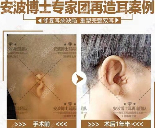 北京米兰柏羽丽都安波耳再造前后对比照