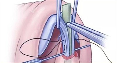 BSK生态肋软骨隆鼻的优势2