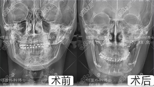 何锦泉正颌术前术后