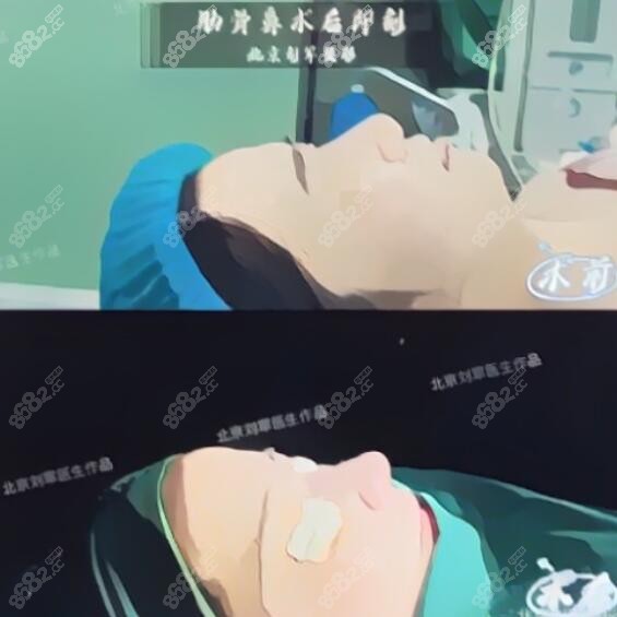 北京刘军医生做肋骨鼻修复的真人术前术后即刻对比照