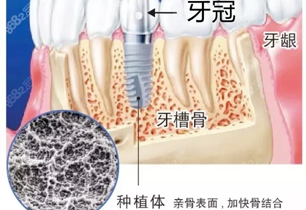 种植体在牙槽骨内的图