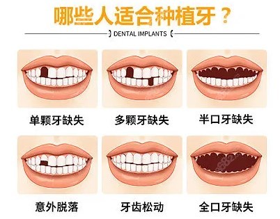 需要做种植牙的人群