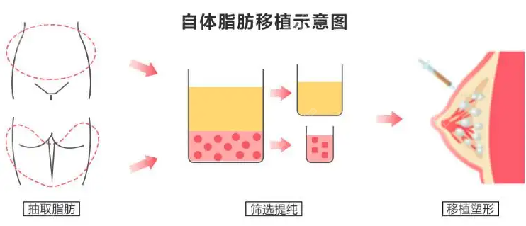 杭州自体脂肪隆胸哪家医院好