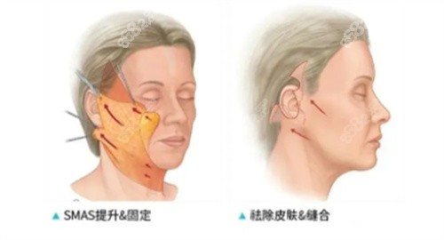 面部提升